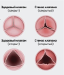 Заболевания сердечных клапанов – это не просто дискомфорт, а серьезная угроза здоровью и жизни