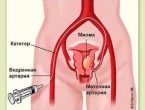 В ММЦ имени Н.И.Пирогова впервые выполнена эндоваскулярная гинекологическая операция 