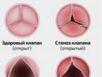 Заболевания сердечных клапанов – это не просто дискомфорт, а серьезная угроза здоровью и жизни